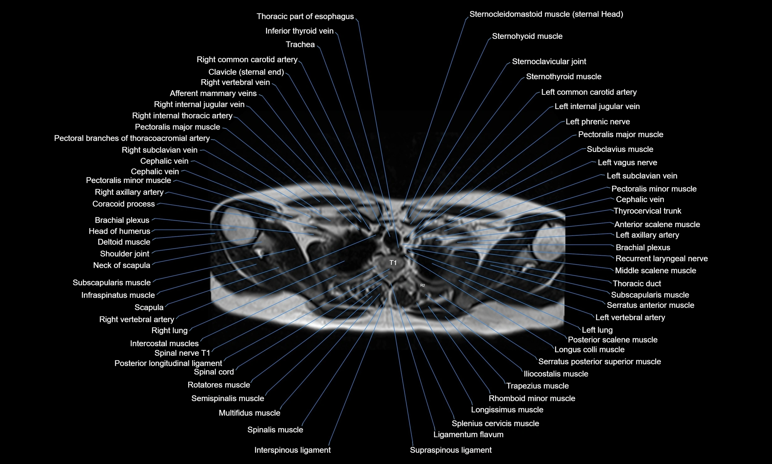 MRI chest axial  cross sectional anatomy 3T radiology  image-img-00001-00007.webp